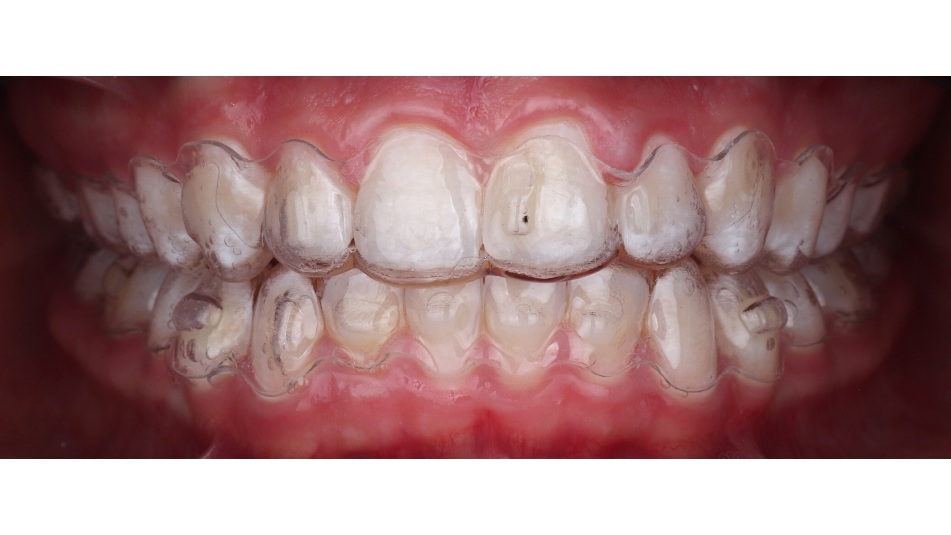 Ortodoncia con Alineadores