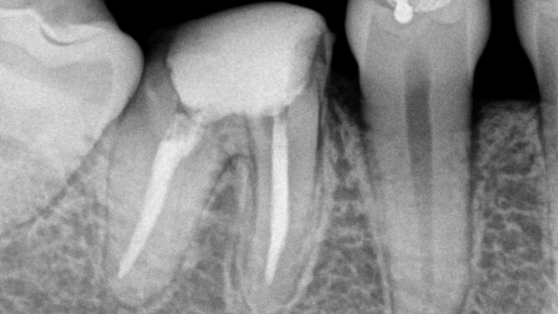 Endodoncia