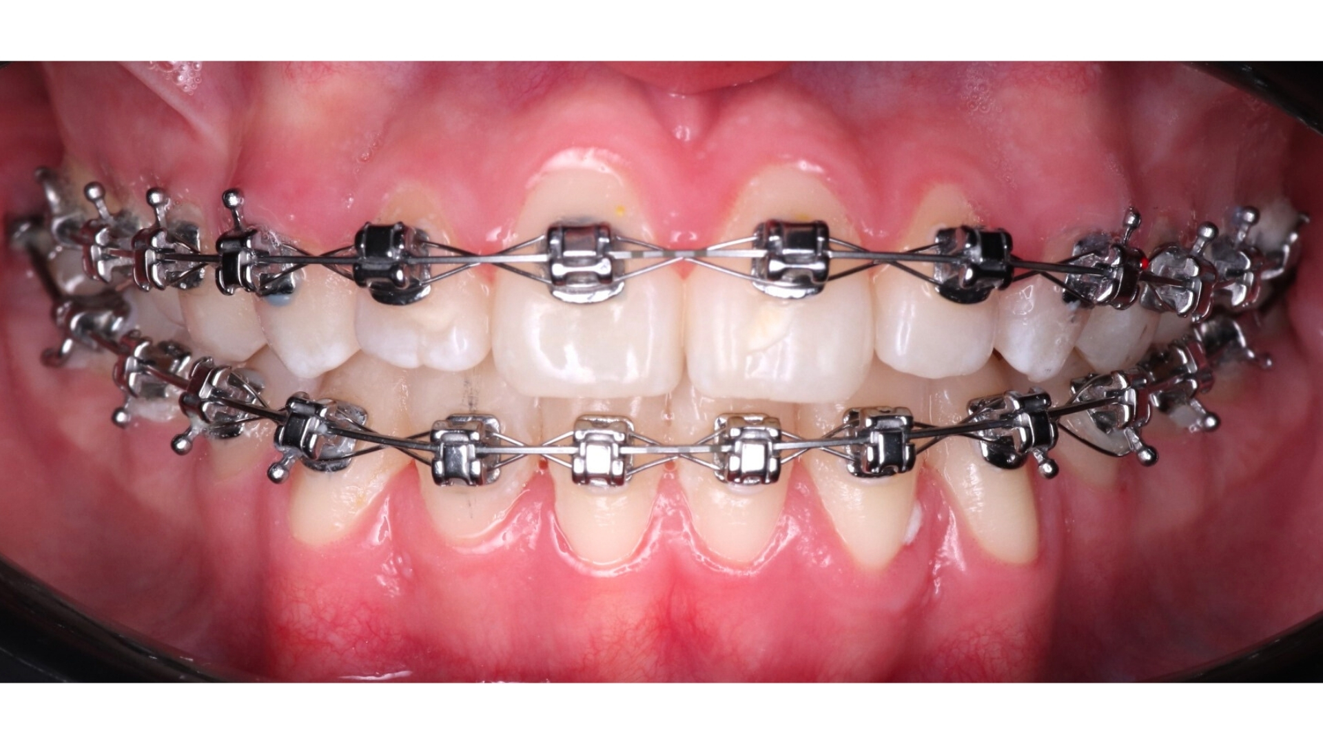 Ortodoncia con Brackets